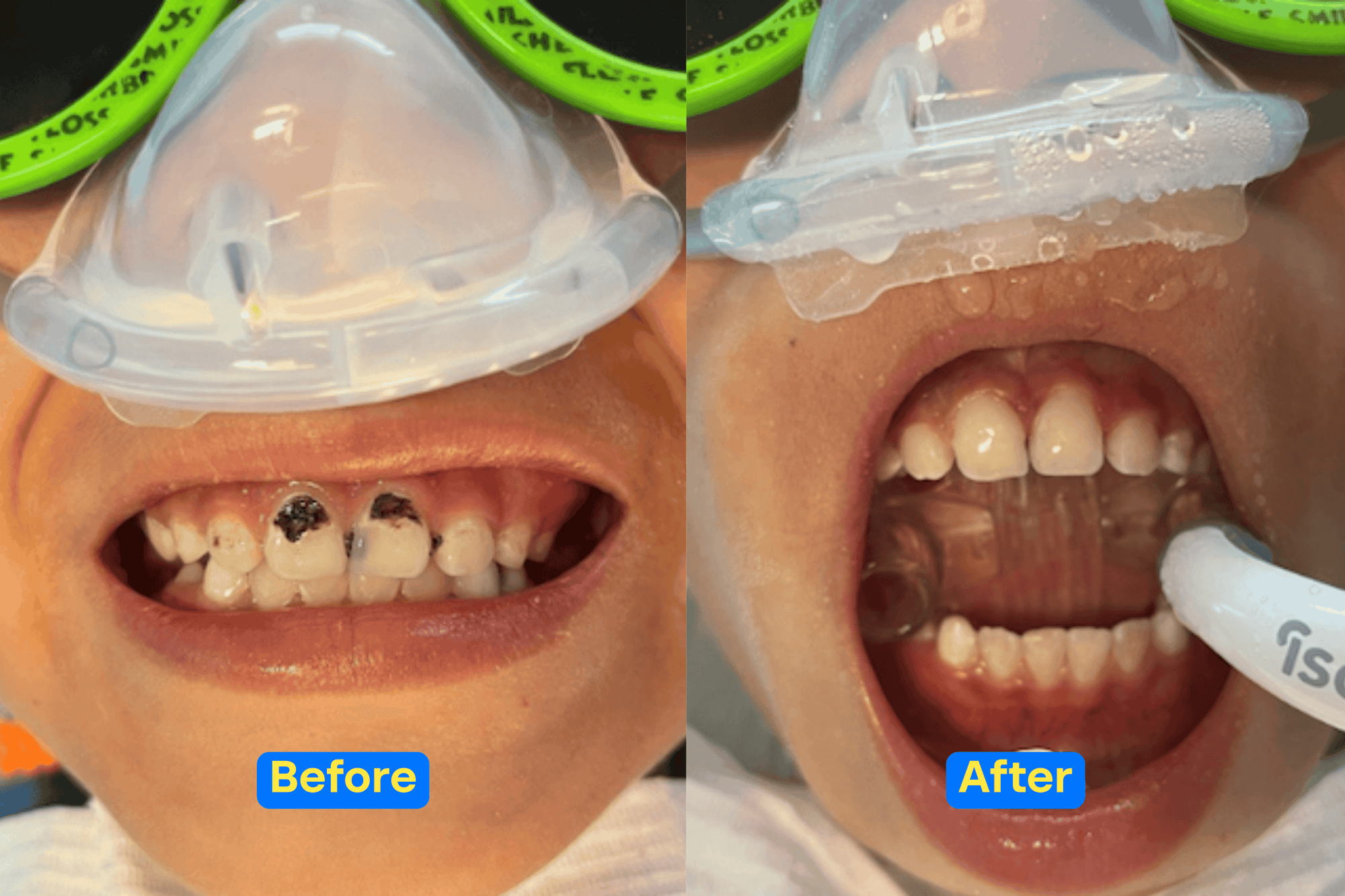 Dental care